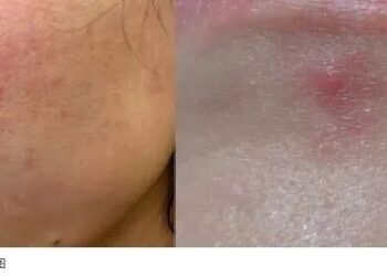 「烂脸」的年轻人，买爆药妆