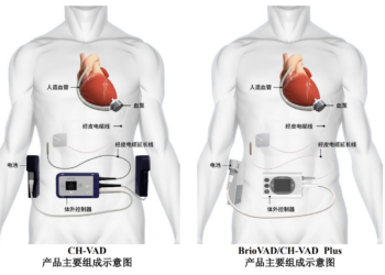 同心医疗科创板IPO获受理 竞速「国产人工心脏第一股」